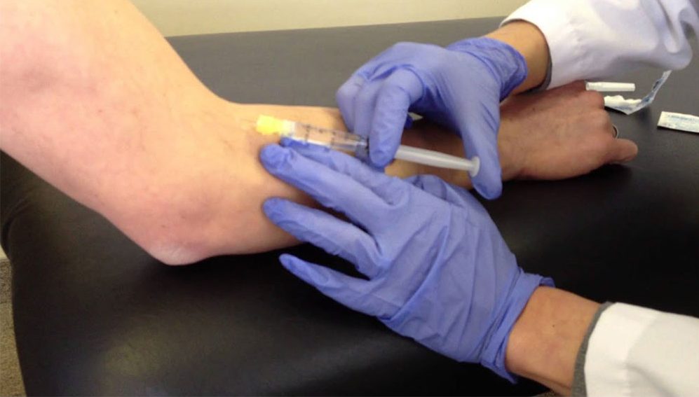 Dirsek bölgesine uygulanan ağrı mezoterapisi enjeksiyonu