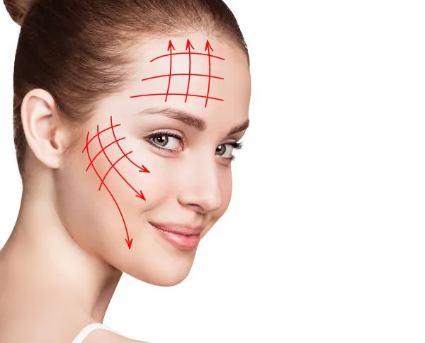 Fransız askısı ile ameliyatsız yüz germe – sütür yönleri şeması