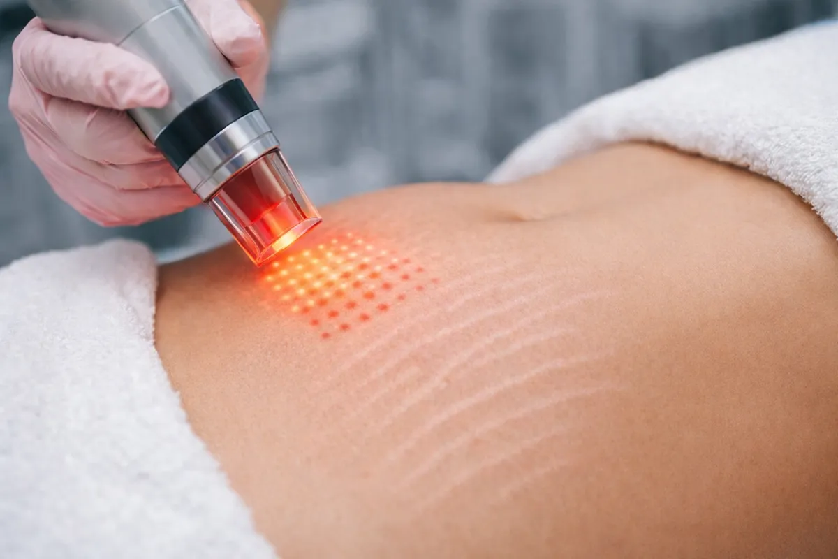 Çatlak tedavisinde fraksiyonel lazer uygulaması sırasında cilt yüzeyinde mikrokanallar oluşturan lazer başlığının yakın plan görüntüsü