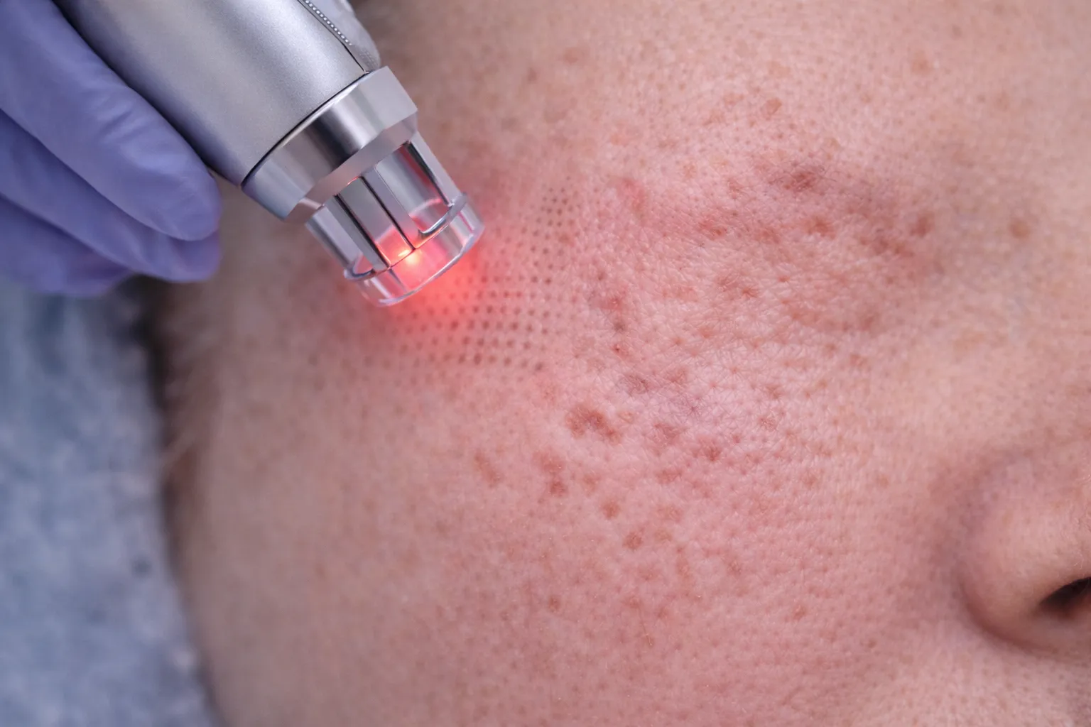 Akne izi bulunan cilt alanına fraksiyonel lazer uygulaması sonrası noktasal izler.