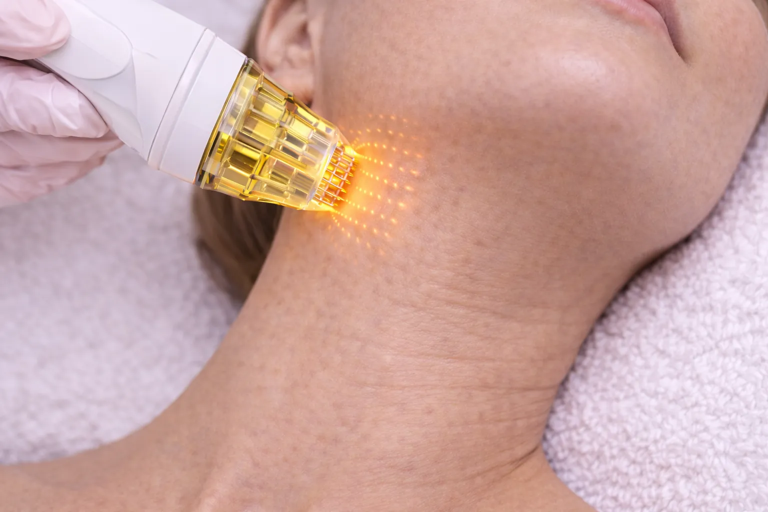 Boyun bölgesinde cilt yenilenmesi ve sıkılaşma amacıyla uygulanan altın iğne (mikroiğneli RF) tedavisi