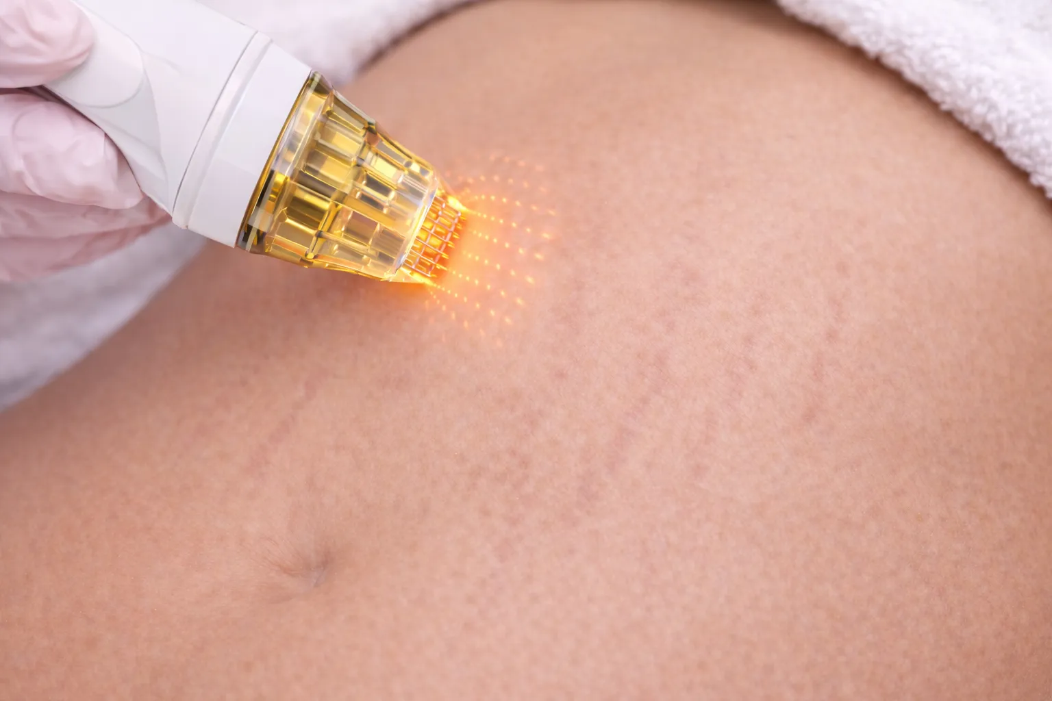 Cilt çatlaklarının görünümünü azaltmaya yönelik altın iğne (mikroiğneli RF) uygulamasının yakın plan görüntüsü