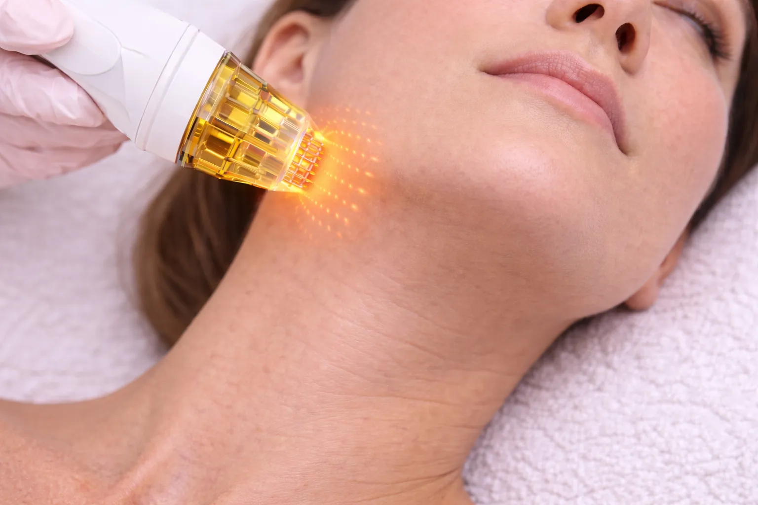 Çene hattı ve gıdı bölgesinde sıkılaşma amacıyla uygulanan altın iğne (mikroiğneli RF) tedavisinin klinik görüntüsü