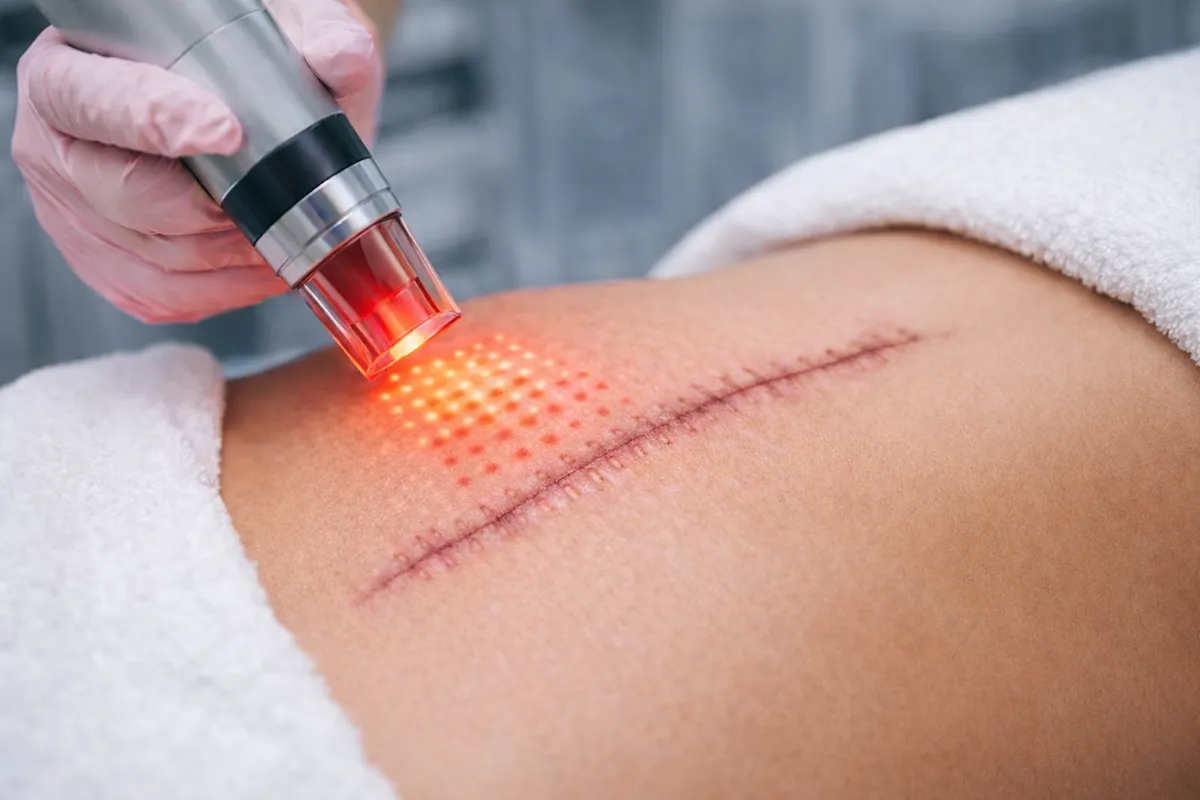 Cerrahi iz tedavisinde fraksiyonel lazer uygulaması sırasında iz dokusu üzerinde mikrokanallar oluşturan lazer başlığının yakın plan görüntüsü