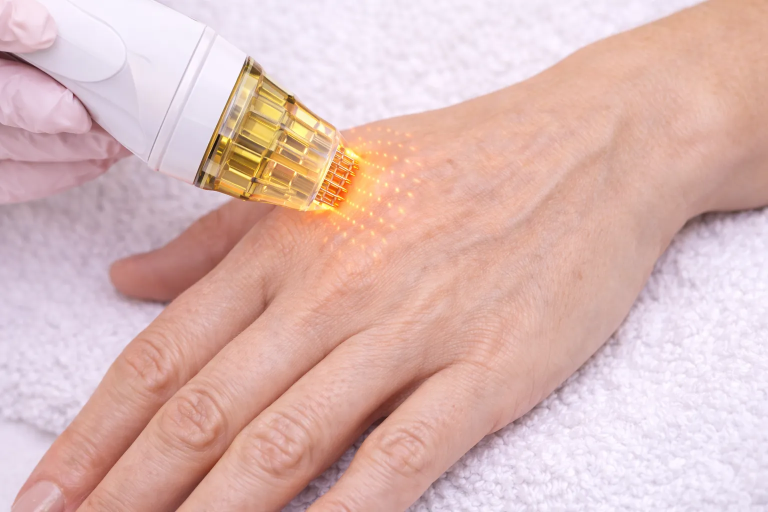 El sırtında cilt yenilenmesi ve gençleştirme amacıyla uygulanan altın iğne (mikroiğneli RF) tedavisi